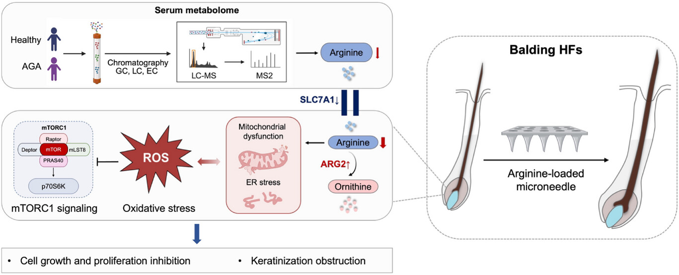 Adv Sci 2025 — Arginine metabolic disruption in androgenetic alopecia