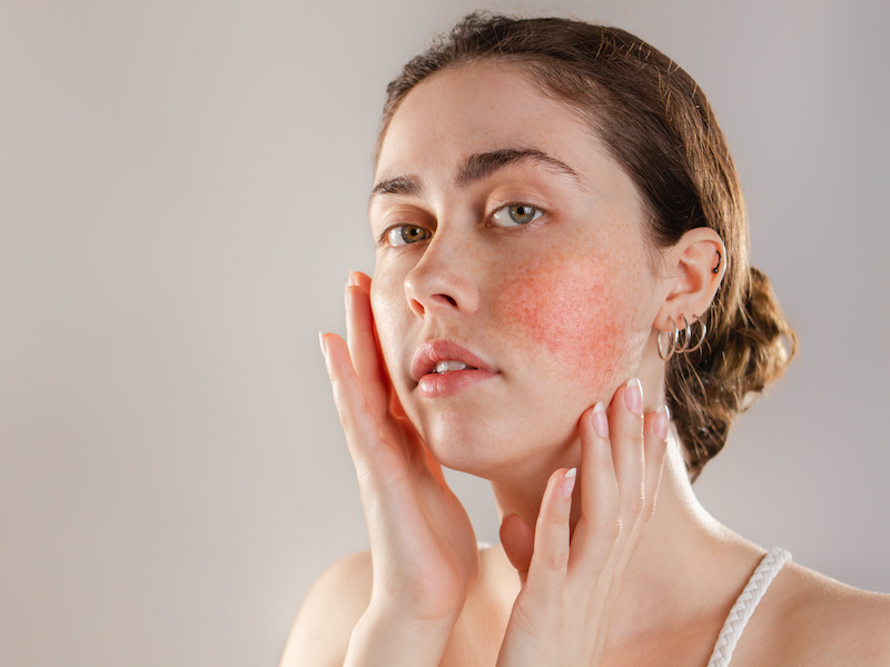 Image for A Novel Convolutional Neural Network for the Diagnosis and Classification of Rosacea: Usability Study